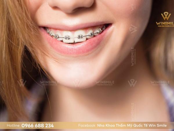 Các phương pháp niềng răng hàm trên - Niềng răng hô hàm trên có lâu không?