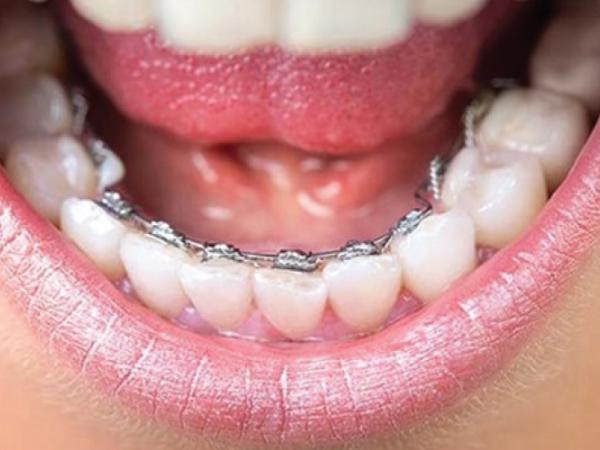 Niềng răng mắc cài mặt lưỡi(mặt trong)
