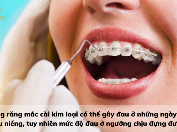 Niềng răng mắc cài kim loại đau không? Cách giảm đau khi niềng răng mắc cài