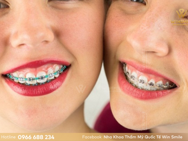 Răng hô hàm trên có ảnh hưởng gì không? Giải pháp hiệu quả tạm biệt răng hô