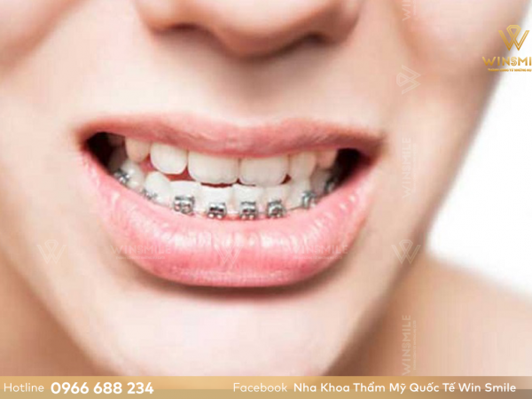 Quy trình niềng răng móm chuẩn 6 bước bạn nên biết
