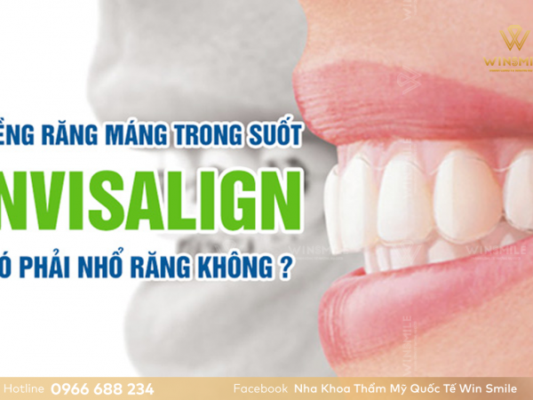 Niềng răng Invisalign có nhổ răng không? Trường hợp cần nhổ răng tạo khoảng?