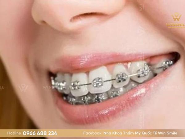 Niềng răng hô nhẹ- Giải pháp giúp bạn nhanh chóng tìm lại một nụ cười tự tin