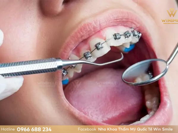 Niềng răng móm có phải nhổ răng không? Các giải pháp thay thế nhổ răng là gì?