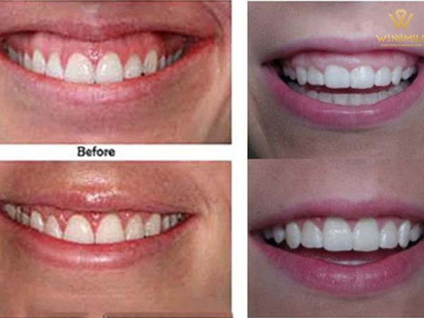 Phẫu thuật cắt cơ nâng môi trên - Điều trị cười hở lợi hiệu quả