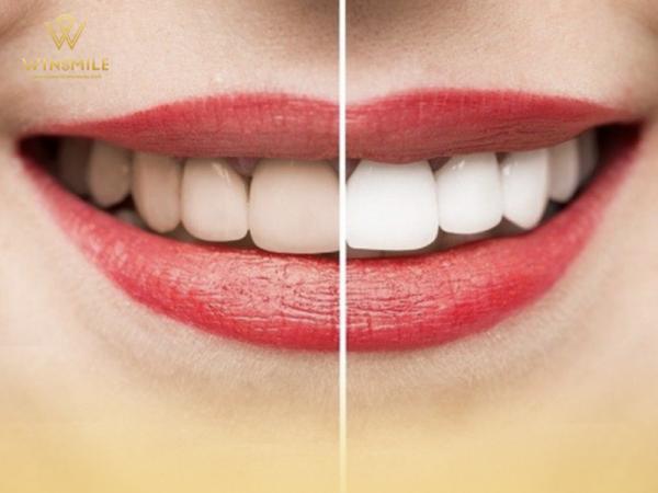 Góc nhìn sự thật về tẩy trắng răng có hại không?
