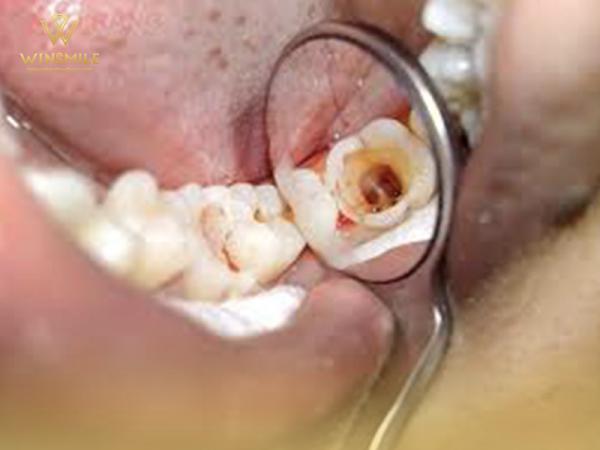 Trẻ em bị sâu răng hàm thì phải làm sao? Nguyên nhân và cách chữa trị