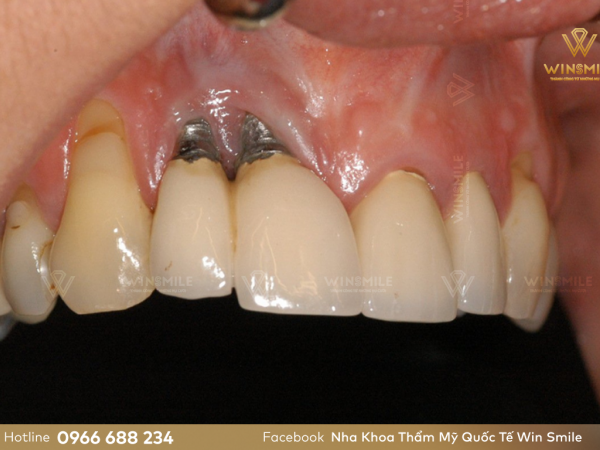 Trồng răng implant giá rẻ - Lợi bất cập hại