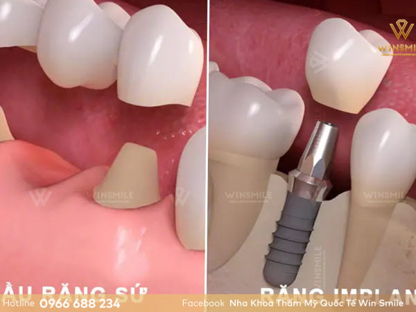 So sánh trồng răng Implant và cầu răng sứ? Điểm giống và khác nhau là gì?