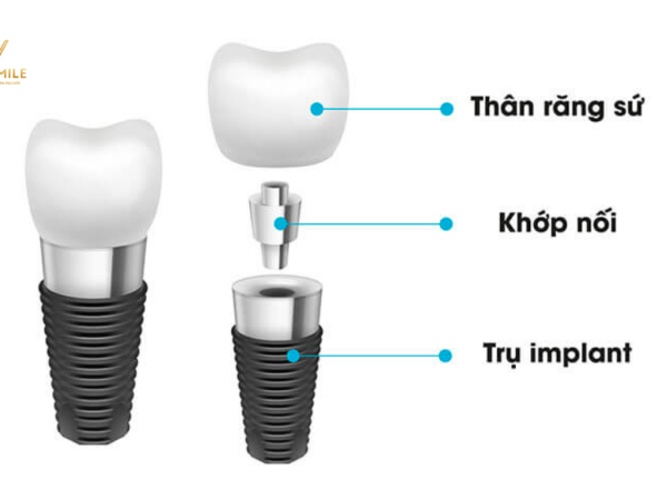 Trồng răng Implant là gì? Chi phí bao nhiêu? Khi nào cần trồng răng Implant?