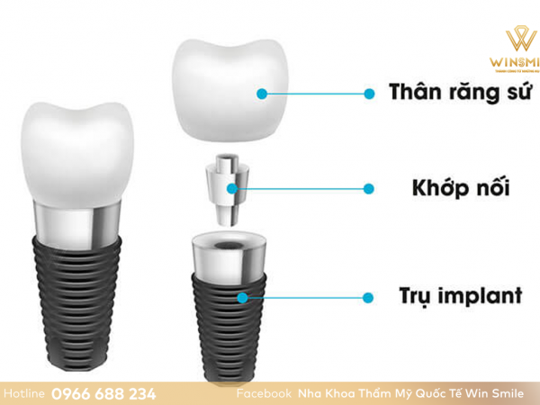 Cấu tạo răng Implant như thế nào? Cách chọn trụ Implant phù hợp nhất