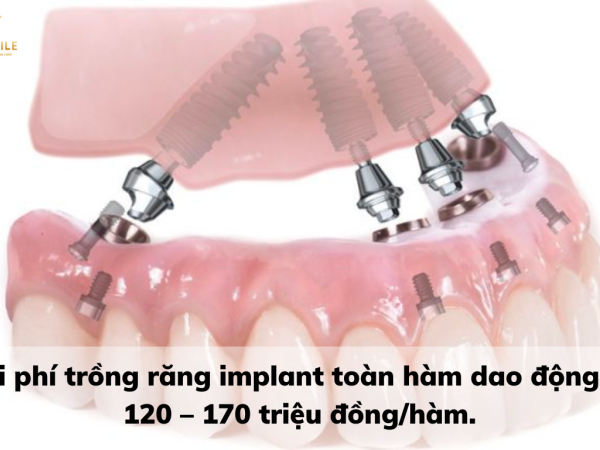Trồng răng Implant toàn hàm giá bao nhiêu? Có được trả góp không?