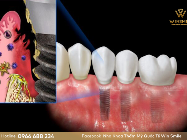 Tác hại của trồng răng Implant là gì? Cách phòng ngừa biến chứng