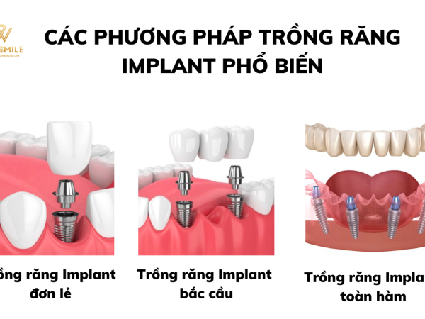 Các phương pháp trồng răng Implant đang áp dụng phổ biến hiện nay
