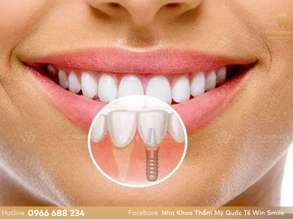 5 lý do quyết định có nên trồng răng Implant không?