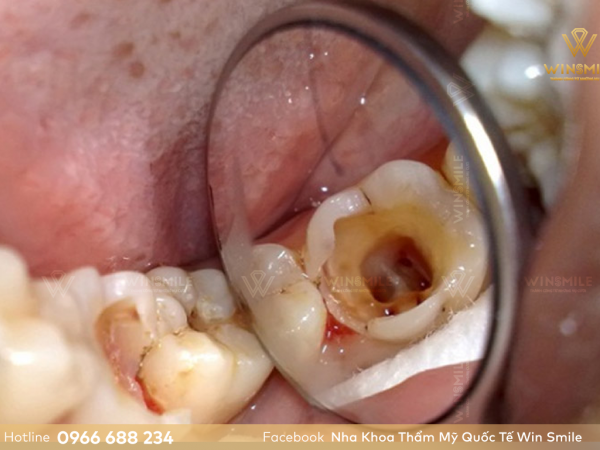 Răng sâu khi nào cần nhổ? Trồng răng sâu bằng cách nào hiệu quả