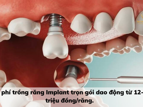 Trồng răng Implant trọn gói bao nhiêu tiền? Ưu điểm khi phục hình Implant trọn gói